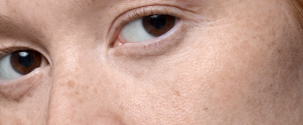 Does Epiderm Cream Remove Pimples and Dark Spots? Let’s Clear Things Up!
